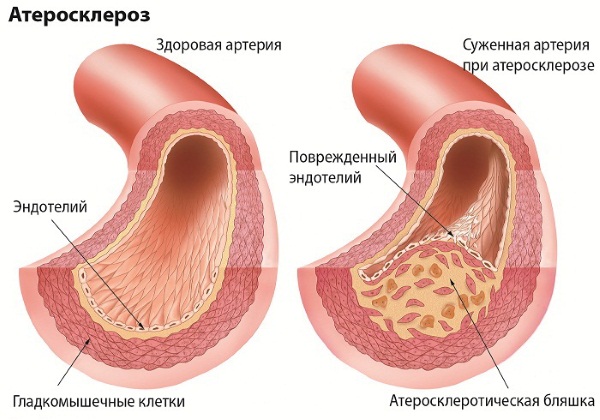 Пентоксифиллин. Инструкция, показания к применению в ампулах, таблетках, противопоказания. Цена, аналоги, отзывы