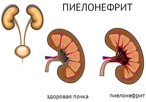 Пиелонефрит у женщин. Симптомы и лечение народными средствами, антибиотики, диета. Причины заболевания почек, классификация