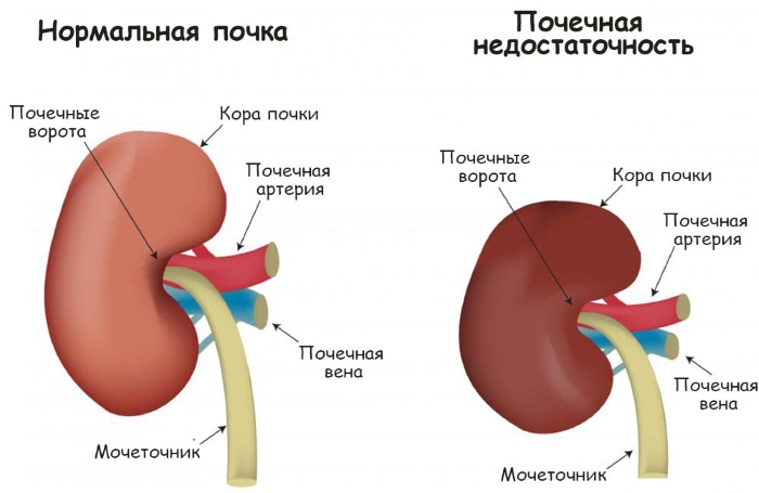 Почечная недостаточность. Симптомы у женщин, острая, хроническая, терминальная, преренальная. Стадии, признаки, причины и лечение