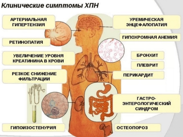 Почечная недостаточность. Симптомы у женщин, острая, хроническая, терминальная, преренальная. Стадии, признаки, причины и лечение