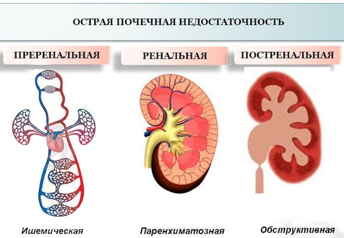 Почечная недостаточность. Симптомы у женщин, острая, хроническая, терминальная, преренальная. Стадии, признаки, причины и лечение