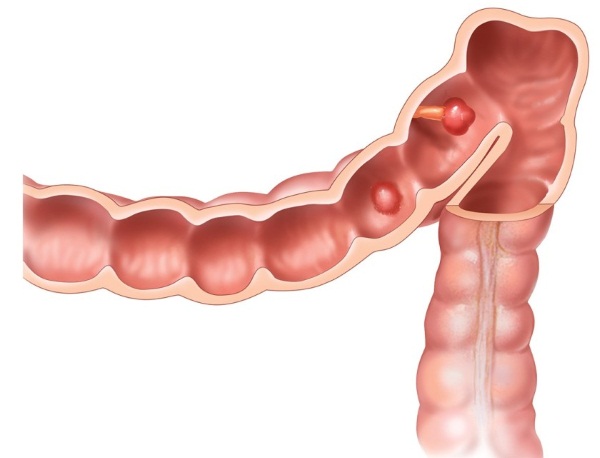 Полипы в кишечнике. Симптомы и лечение, причины образования, признаки. Как обнаружить, удалить, диета, питание, клизма. Анализ крови, операция, какой наркоз
