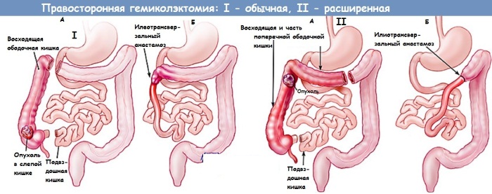 Полипы в кишечнике. Симптомы и лечение, причины образования, признаки. Как обнаружить, удалить, диета, питание, клизма. Анализ крови, операция, какой наркоз