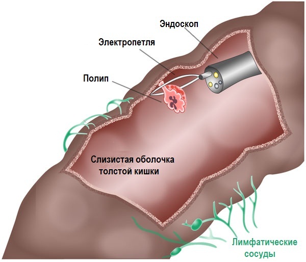 Полипы в кишечнике. Симптомы и лечение, причины образования, признаки. Как обнаружить, удалить, диета, питание, клизма. Анализ крови, операция, какой наркоз