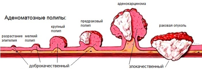 Полипы в кишечнике. Симптомы и лечение, причины образования, признаки. Как обнаружить, удалить, диета, питание, клизма. Анализ крови, операция, какой наркоз