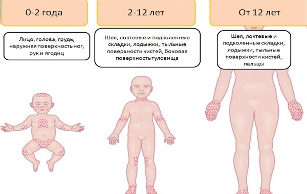 Потничка у новорожденных. Фото, как выглядит, лечение опрелости на лице, шее, ногах, руках, в паху, под мышками