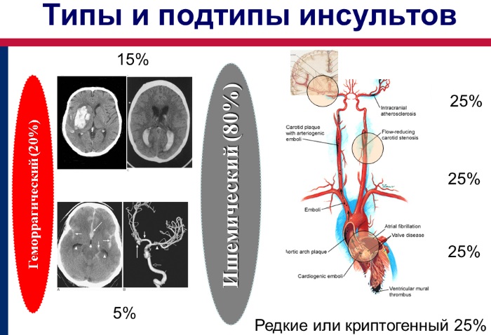 Признаки инсульта у мужчин, симптомы, причины ишемического, геморрагического. Первая помощь, лечение, восстановление, последствия