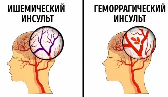 Признаки инсульта у мужчин, симптомы, причины ишемического, геморрагического. Первая помощь, лечение, восстановление, последствия