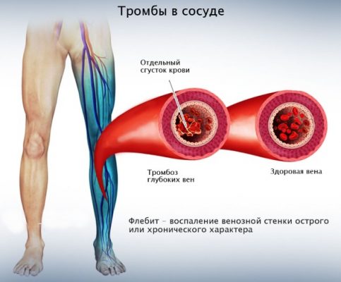 Проблемы с сосудами ног фото