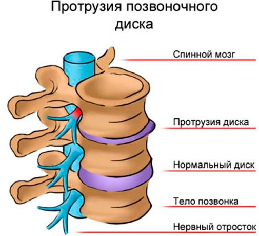 Протрузия дисков позвоночника шейного, пояснично-крестцового отдела. Что это такое, симптомы, как лечить, гимнастика