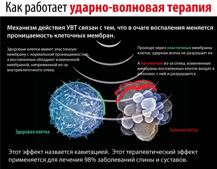 Пяточная шпора. Что это, лечение в домашних условиях народными средствами, ударно-волновой терапией, лазером, медикаментозно