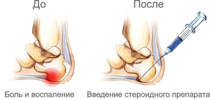 Пяточная шпора. Что это, лечение в домашних условиях народными средствами, ударно-волновой терапией, лазером, медикаментозно