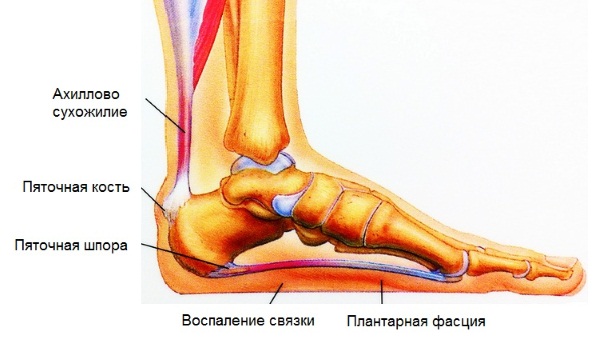 Пяточная шпора. Что это, лечение в домашних условиях народными средствами, ударно-волновой терапией, лазером, медикаментозно