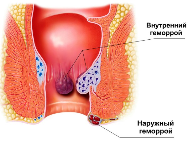 Самое эффективное средство от геморроя: свечи, мази, таблетки, народные средства. Как лечить наружный, внутренний геморрой