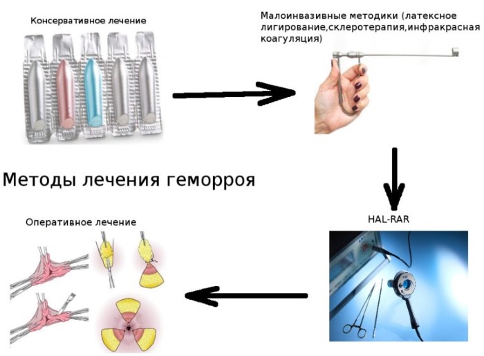 Самое эффективное средство от геморроя: свечи, мази, таблетки, народные средства. Как лечить наружный, внутренний геморрой