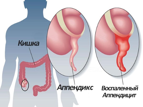 Симптомы аппендицита у женщин, признаки при беременности. Лечение народными средствами, антибиотиками, после операции