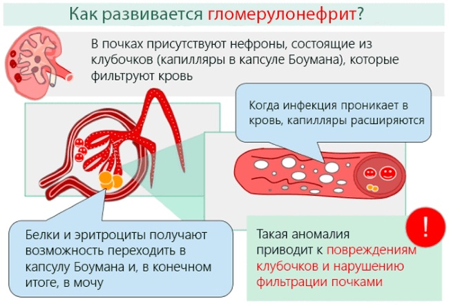 Симптомы болезни почек и лечение народными средствами, препараты, диета, если болят, застужены, воспаление, опущение, киста, гемангиома. Расположение, размеры, норма