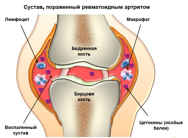 Симптомы и лечение скарлатины у детей, как выглядит горло, язык, сыпь. Стадии, профилактика, инкубационный период, последствия