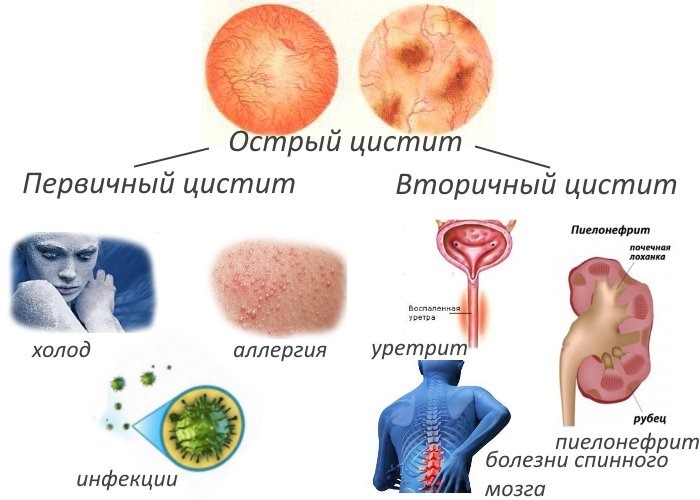 Симптомы и лечение цистита у мужчин. Медикаменты, народные средства, препараты в таблетках, другие лекарства