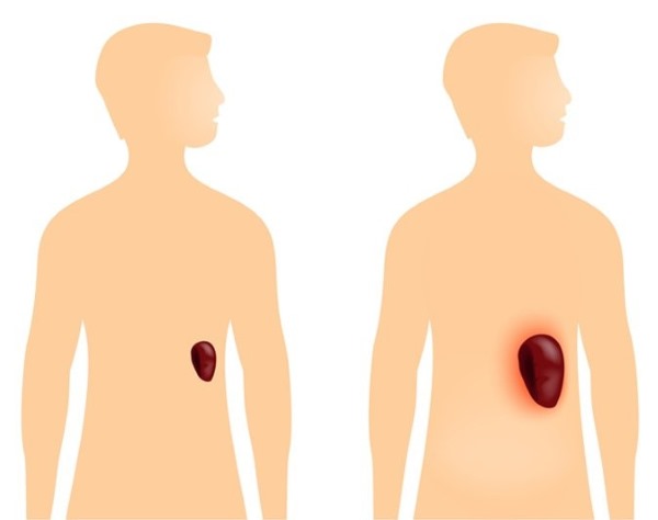 Симптомы, причины и лечение увеличенной селезенки у взрослых и детей. Народные средства, диета