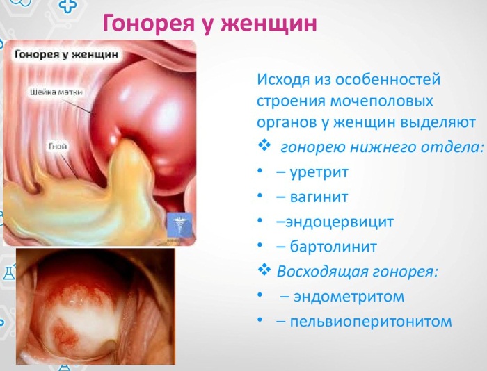 Симптомы венерологических заболеваний у женщин. Обследование и диагностика, инкубационный период, лечение