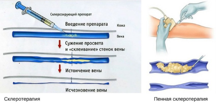 Лопаются сосуды (вены) на ногах. Почему, что делать