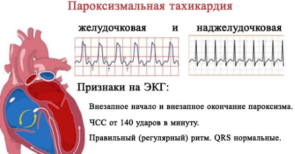 Тахикардия. Симптомы и лечение пароксизмальной, желудочковой, наджелудочковой, синусовой. Диагностика, что делать нельзя