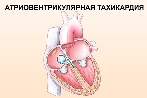 Тахикардия сердца. Причины возникновения, симптомы и лечение