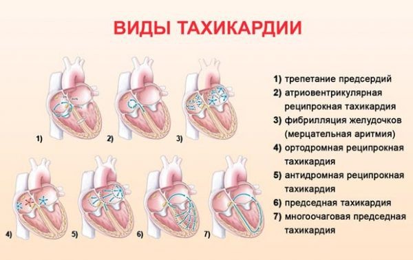 Аритмия сердца. Симптомы, лечение, первая помощь