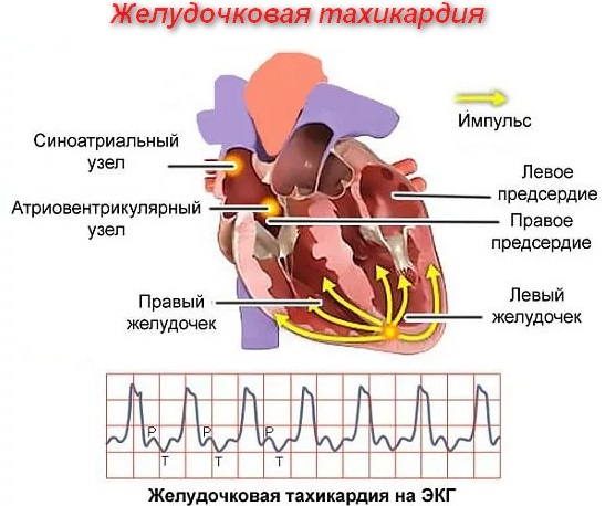 Тахикардия при беременности в 1-2-3 триместре. Лечение