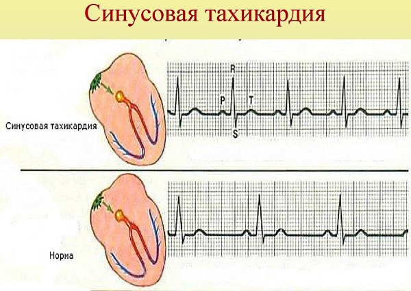 Тахикардия сердца. Причины возникновения, симптомы и лечение