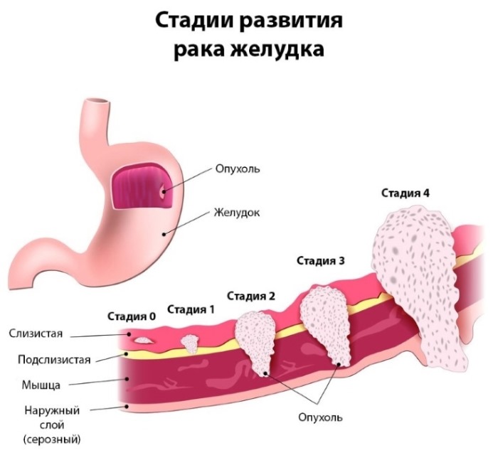 Тошнота и боль в желудке. Причины, симптомы и лечение у женщин, мужчин, детей. Препараты, народные средства