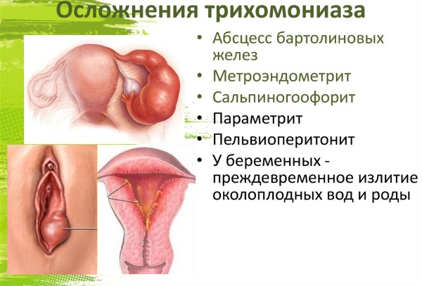 Трихомоноз у женщин. Симптомы и лечение народными средствами, препараты в домашних условиях. Причины возникновения при беременности, менопаузе