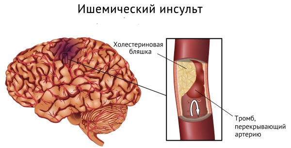 Цикорий растворимый. Полезные свойства, применение, противопоказания, возможный вред
