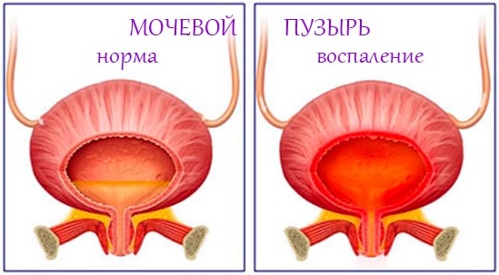 Цистит у женщин. Симптомы и лечение народными средствами, антибиотиками, лекарствами. От чего возникает, последствия