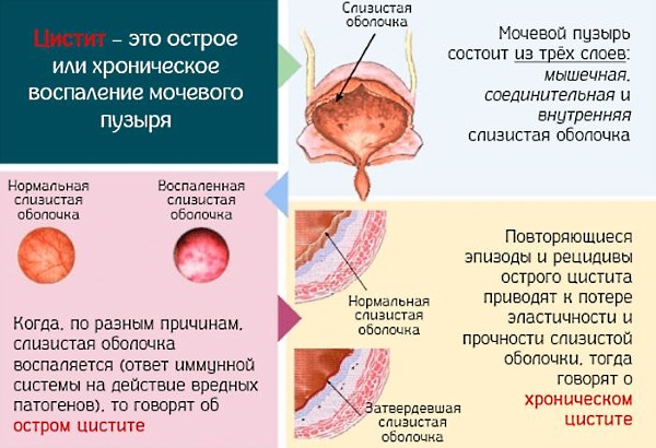 Цистит у женщин. Симптомы и лечение народными средствами, антибиотиками, лекарствами. От чего возникает, последствия