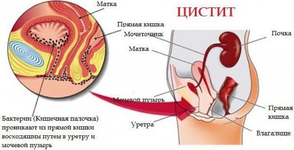 Цистит у женщин. Симптомы и лечение народными средствами, антибиотиками, лекарствами. От чего возникает, последствия