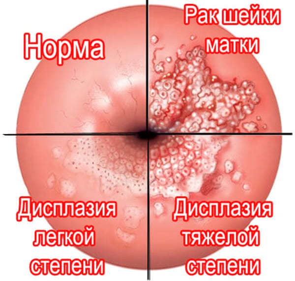 Цитология в гинекологии. Что это такое, виды. Как берут мазок, сколько дней делается, расшифровка