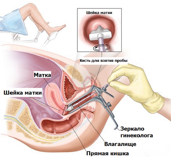 Цитология в гинекологии. Что это такое, виды. Как берут мазок, сколько дней делается, расшифровка