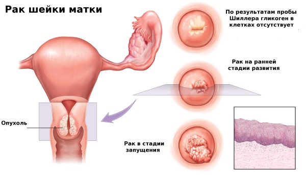 Цитология в гинекологии. Что это такое, виды. Как берут мазок, сколько дней делается, расшифровка