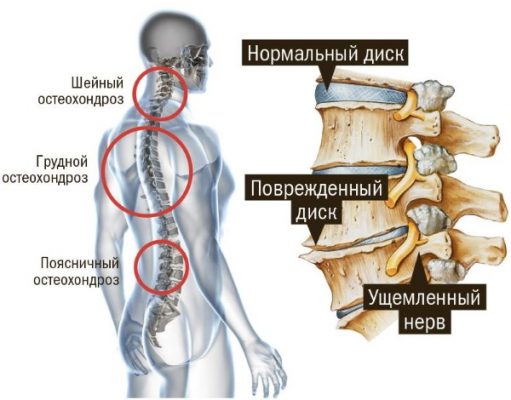 Гимнастика при шейном остеохондрозе в домашних условиях фото пошагово