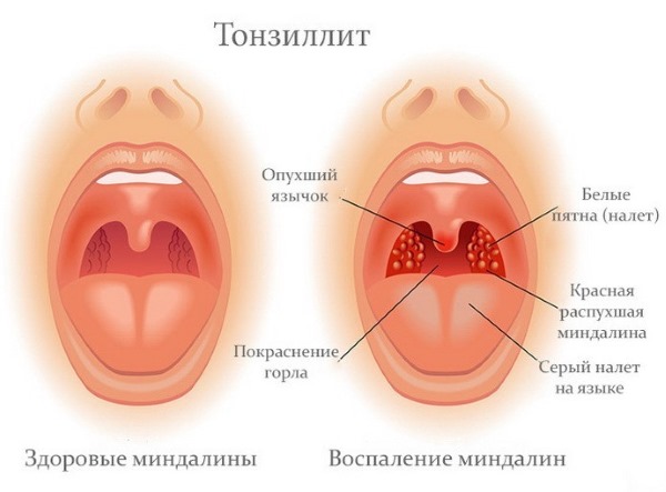 Аденовирусная инфекция у детей. Симптомы и лечение антибиотиками, народные средства