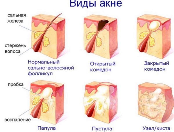 Акне - что это такое, как избавиться от прыщей на лице. Препараты, диета лазерное лечение, мезотерапия