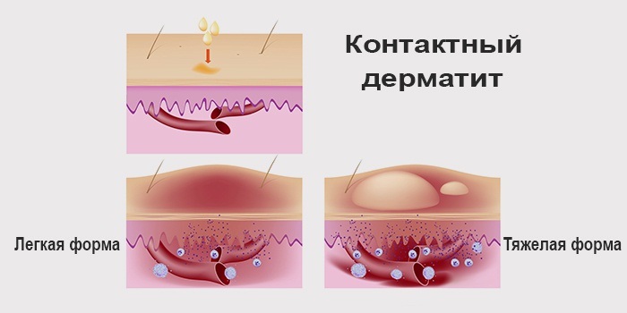 Аллергический дерматит. Лечение у взрослых, причины, симптомы на руках, голове, лице. Диета, мази, препараты в таблетках