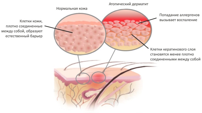 Аллергический дерматит современное лечение thumbnail