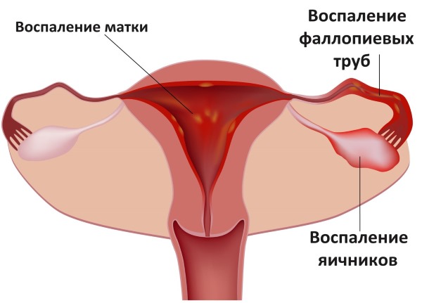 Апоплексия яичника. Что это такое, симптомы, как лечить, последствия выжигания, рекомендации