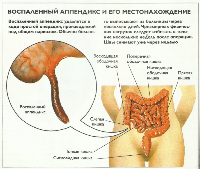 Аппендицит. Симптомы у взрослых мужчин. Стадии, осложнения, диагностика, УЗИ, лечение, диета, операция