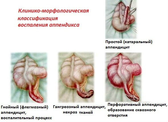 Аппендицит. Симптомы у взрослых мужчин. Стадии, осложнения, диагностика, УЗИ, лечение, диета, операция