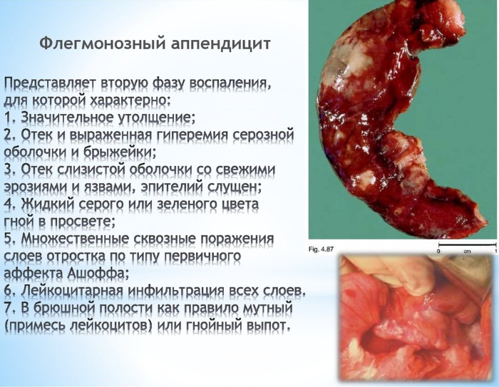Аппендицит. Симптомы у взрослых мужчин. Стадии, осложнения, диагностика, УЗИ, лечение, диета, операция