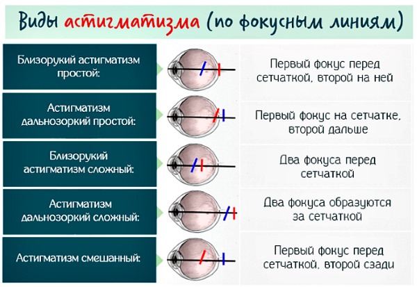 Астигматизм у детей. Лечение: линзы, очки, лазерная коррекция, операция